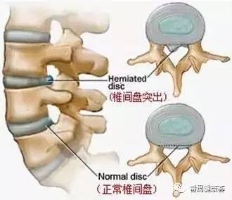 9岁小胖墩腰椎间盘脱出警示，儿童健康不容忽视