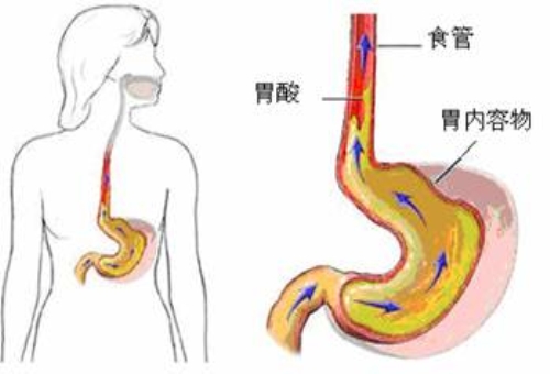 女子因胃食管反流被迫坐着睡觉2年多